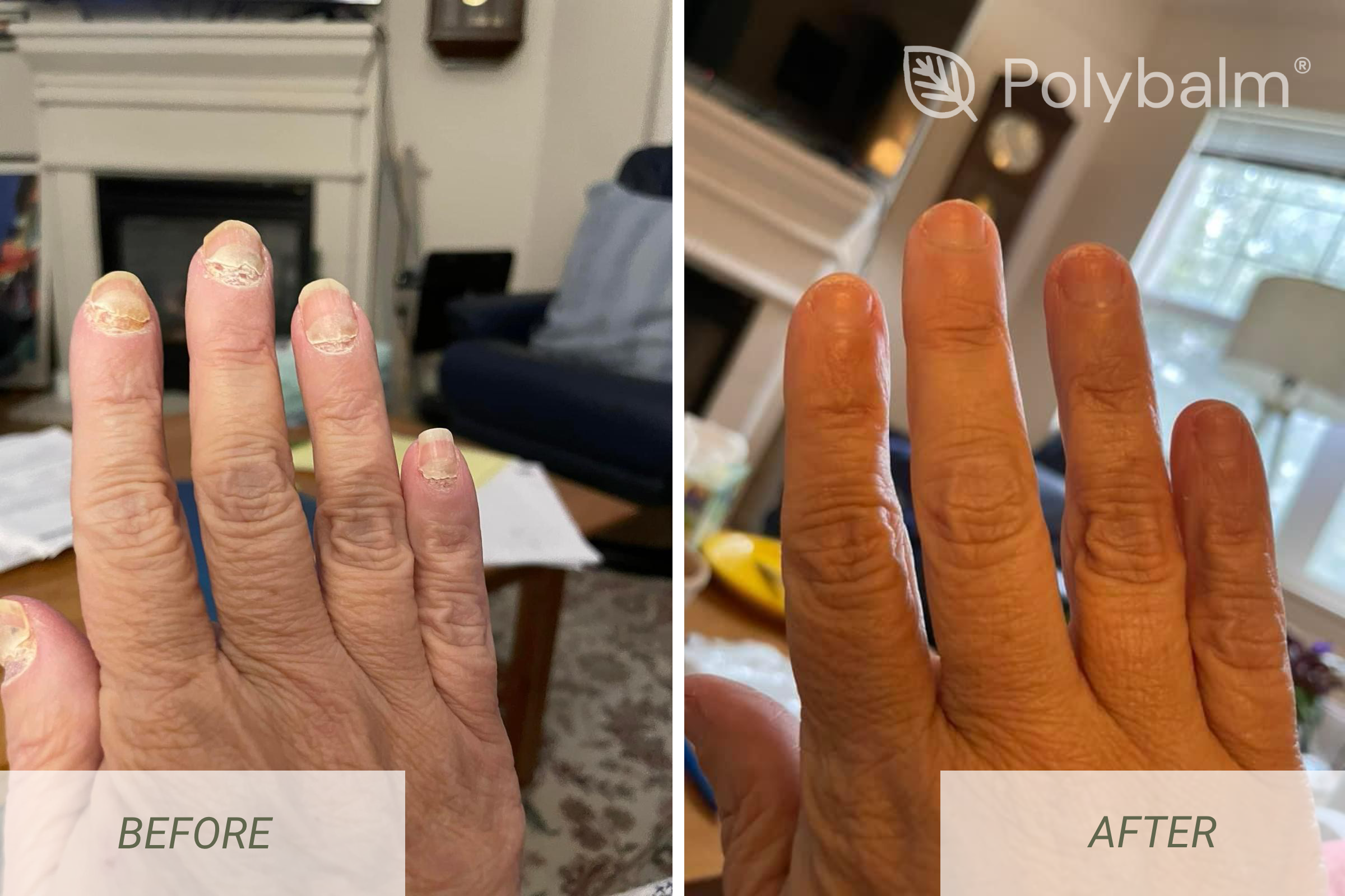 Before vs After using Polybalm®